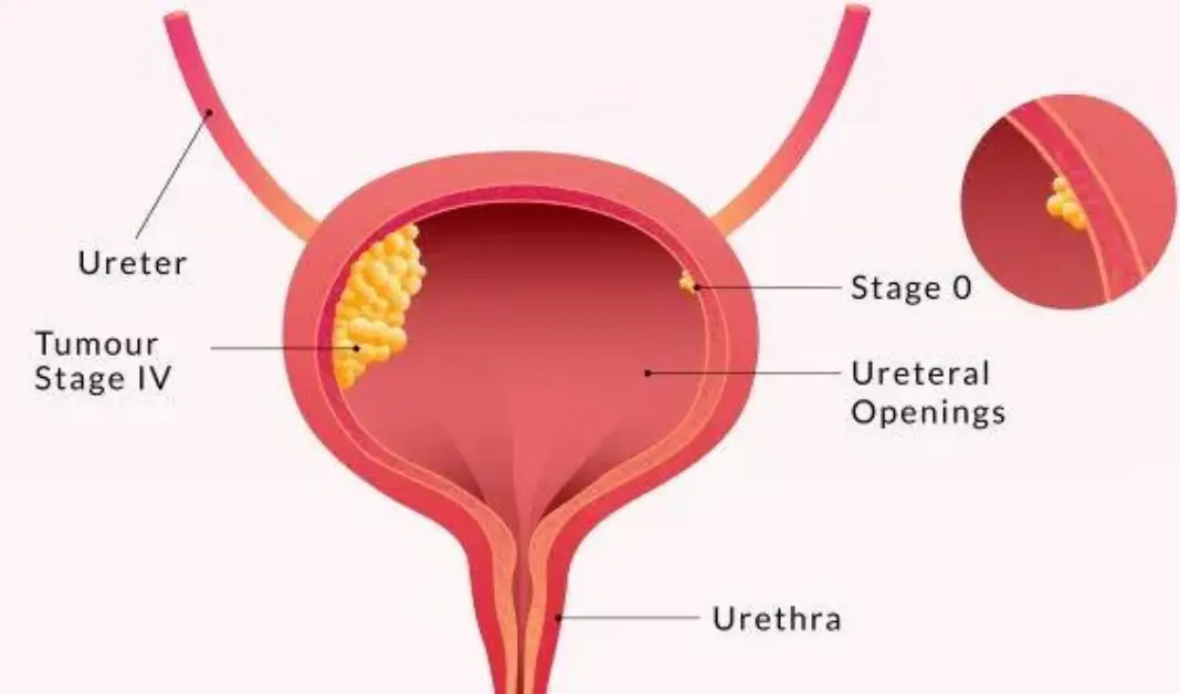 bladder cancer symptoms