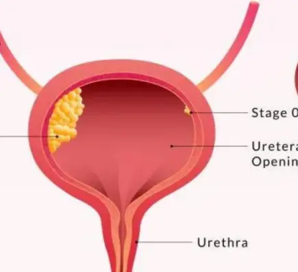 bladder cancer symptoms