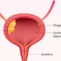 bladder cancer symptoms