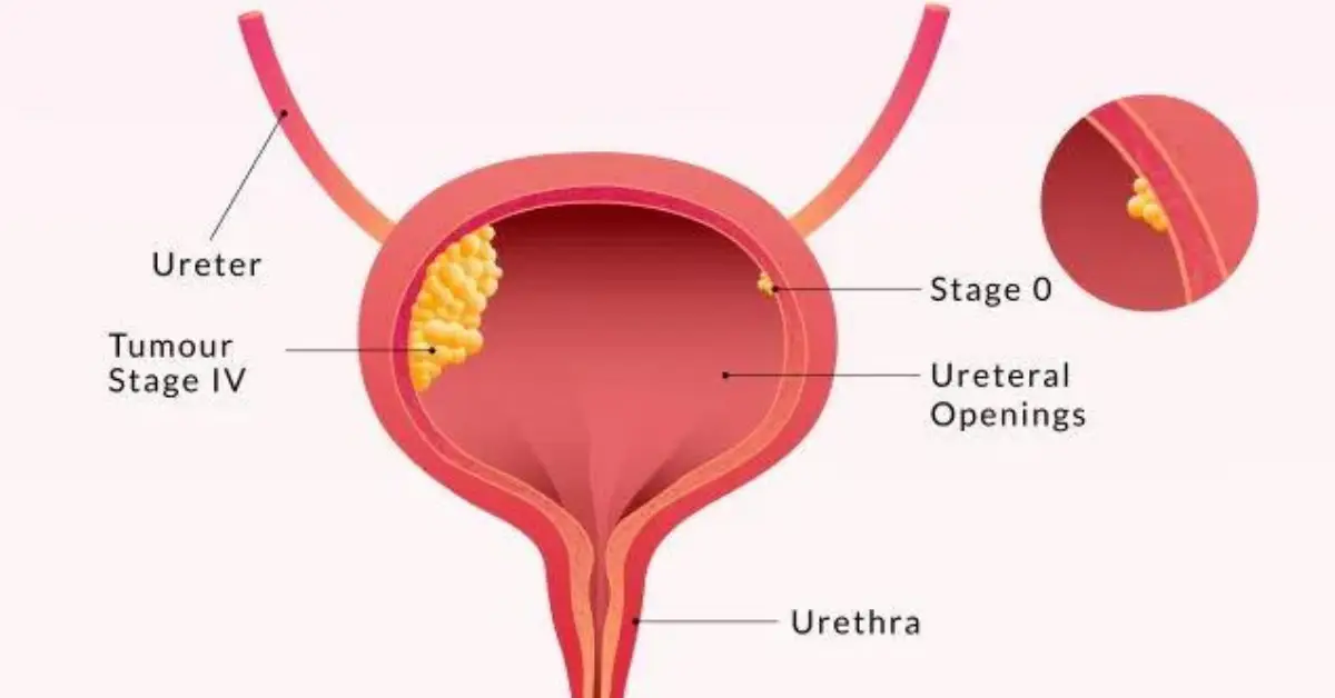 bladder cancer symptoms