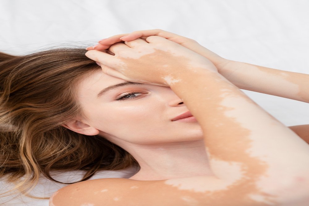A person with vitiligo lies on a white surface, one arm resting on their forehead, gazing calmly at the camera.