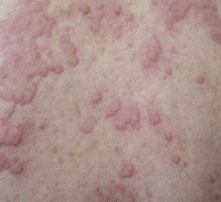 Chronic Spontaneous Urticaria 101