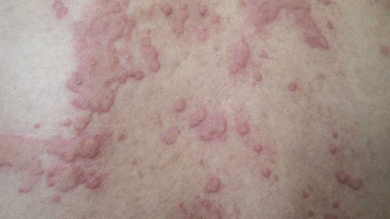 Chronic Spontaneous Urticaria 101