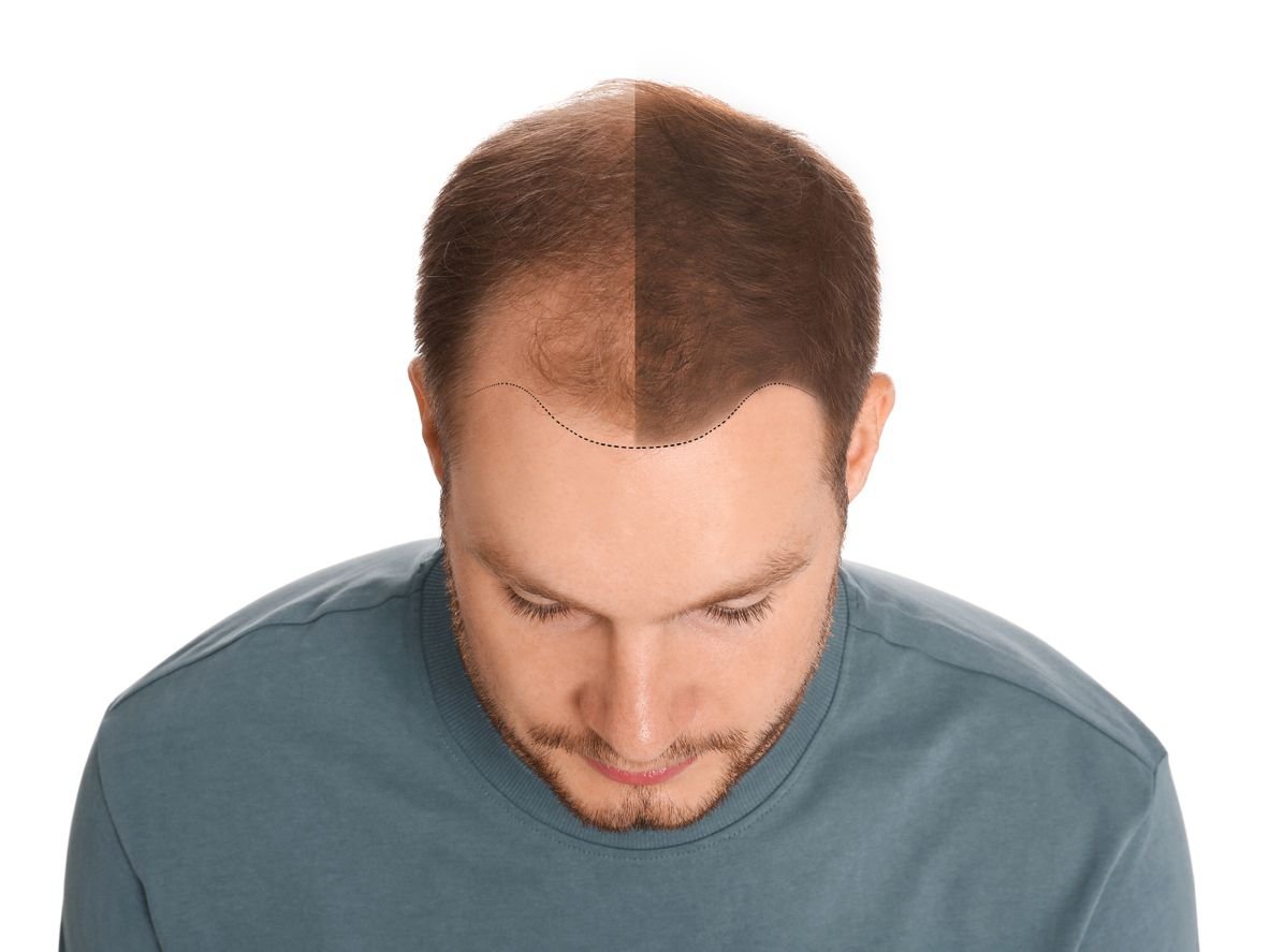 Does Finasteride work for receding hairlines?