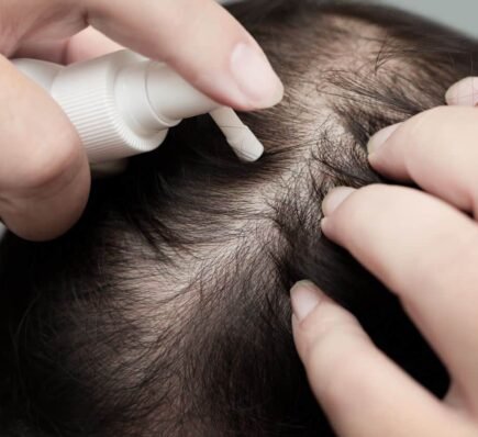 Oral vs. topical Minoxidil: Which is better for my hair loss?