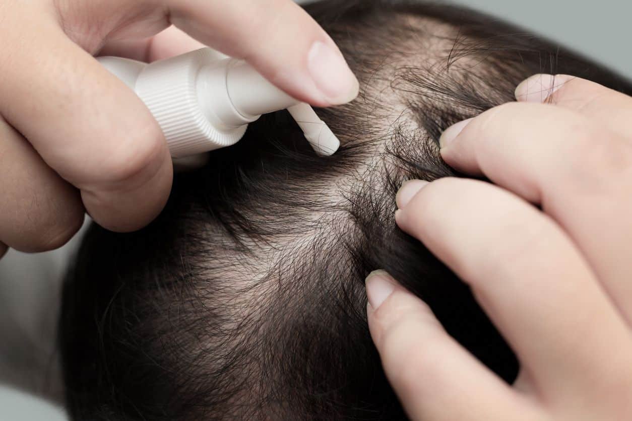 Oral vs. topical Minoxidil: Which is better for my hair loss?