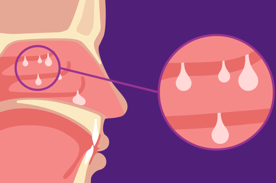 What’s the Connection? Nasal Polyps and Coexisting Conditions