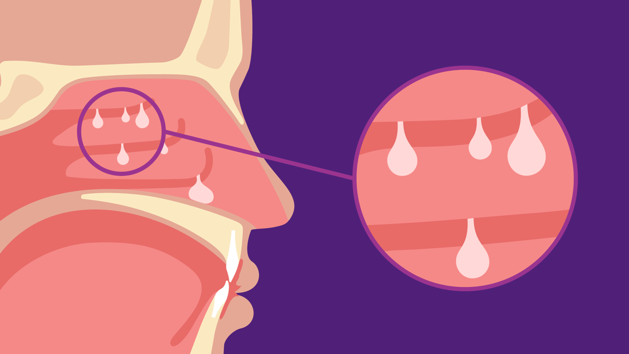 What’s the Connection? Nasal Polyps and Coexisting Conditions