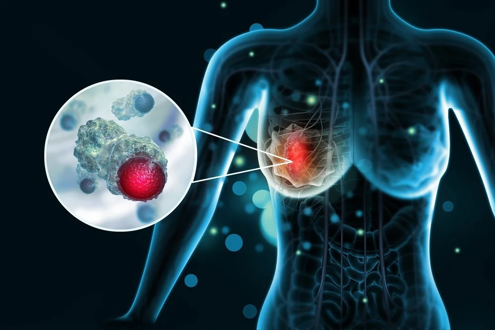 The Role of Hormones in Breast Cancer Development: